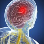 மூளைக் கட்டிகளில் மூடநம்பிக்கைகள்