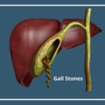 பித்தப்பையில் கற்கள் ஏன்?