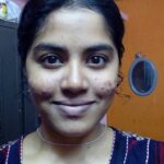 முகப்பரு வராமல் தடுக்கலாமுங்க