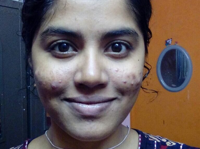 முகப்பரு வராமல் தடுக்கலாமுங்க