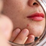 மரு அகற்றினாலும் மீண்டும் வருமா…?