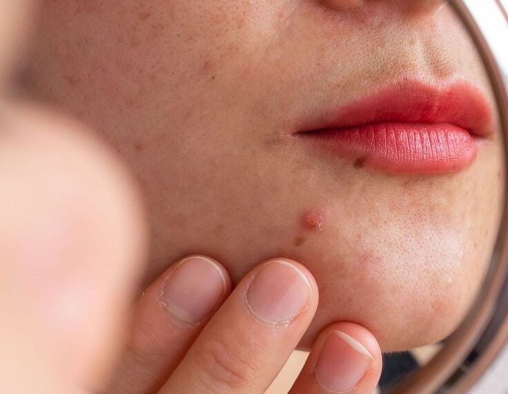 மரு அகற்றினாலும் மீண்டும் வருமா…?